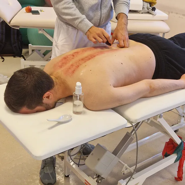 Narbenentstörung – Narbenpflege 