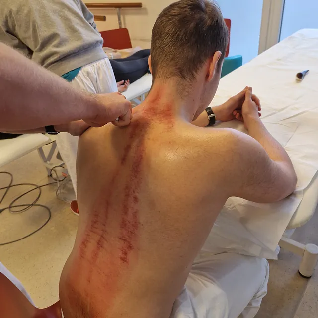 Narbenentstörung – Narbenpflege 